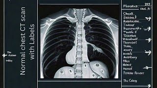 quotNormal Chest CT Scan Explained Detailed Anatomy with Labelsquot [upl. by Imnubulo]