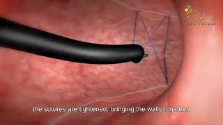 ENDOSCOPIC SLEEVE GASTROPLASTY [upl. by Calder867]