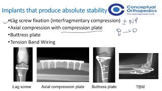 AO Principles of Fracture Management Learn Important Concepts  Conceptual Orthopedics [upl. by Nabroc]