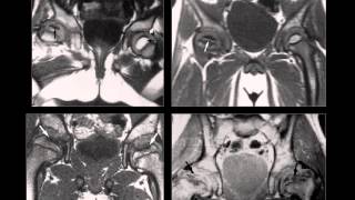 Osteocondrosis Osteocondritis Osteonecrosis Infarto Oseo Radiologia Radiografiaswmv [upl. by Nostets537]