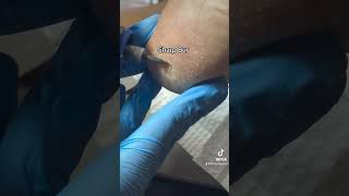 Painful Heel Porokeratosis Removal [upl. by Atnes]