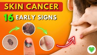 16 Early Signs of Skin Cancer You Should Never Ignore  Melanoma  Skin Cancer Symptoms [upl. by Nisa]