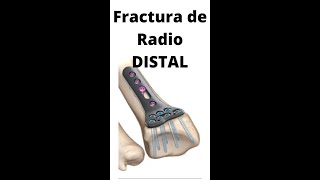 FRACTURA DE RADIO DISTAL [upl. by Salokcin]