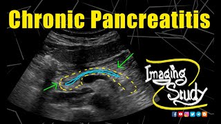 Chronic Pancreatitis  Ultrasound  Case 168 [upl. by Waterer]