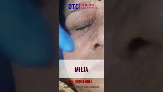 Milia extractionDr Rohit Goel [upl. by Suaeddaht98]