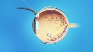 Macular Hole Vitrectomy Surgery [upl. by Ocirne]