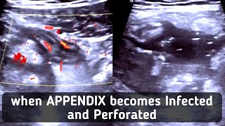 Ultrasound Complicated Perforated Appendicitis [upl. by Ehc]