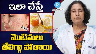 Best treatment for Pimples  Acne explained by Dr Chandravathi Dermatologist  Telugu Popular TV [upl. by Phedra]