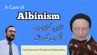 Albino  Albinism  Oculocutaneous Albinism  Why Are Some Children Albino  Practice Of Optometry [upl. by Alcus]