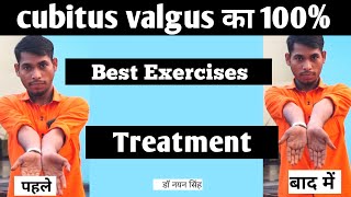 cubitus valgus bilateral treatment in hindi cubitus valgus vs varus  physiotherapy exercises [upl. by Nahtannoj]