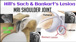 Bankarts Lesion  Hill Sachs Lesion  MRI RIGHT SHOULDER JOINT [upl. by Tiffa]