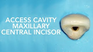 Pre Clinical Endodontic  Access Cavity of Maxillary Central Incisor [upl. by Calista742]