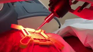 LIVE ARTAS Robotic Hair Transplant Procedure  ARTAS in Action [upl. by Gilford276]