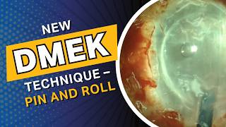 New DMEK technique – Pin and Roll [upl. by Hermy]