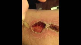 scab removal [upl. by Hesler]