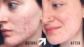 How To Fade Hyper Pigmentation And Acne Marks using At Home Treatments [upl. by Yurik]