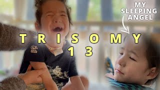 Trisomy 13 Sometimes I forget about my sons profound disability Patau Syndrome [upl. by Tebazile18]