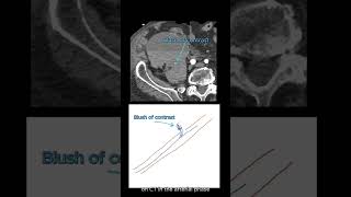 Active bleed extravasation on CT radiology [upl. by Jennee]