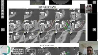 MatBorTorCas  Exodontia dos Sisos com Piezo e biomaterial [upl. by Crelin]