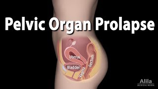 Pelvic Organ Prolapse Animation [upl. by James]