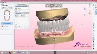 Digital Full Denture Design [upl. by Eimmelc]