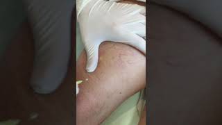 Escleroterapia con microespuma de cara lateral externa de muslo [upl. by Almeda]