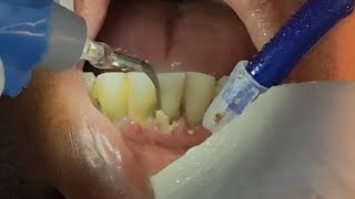 profissional teeth cleaning 🧹 this tartar is really amazing its strong like iron [upl. by Nnod876]