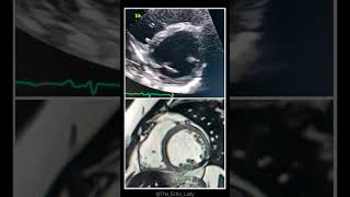 Whats the Ejection fraction 🤔🫀 MRI cardiacMRI Radiology Radiologia [upl. by Woothen]