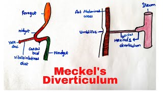 Meckels Diverticulum [upl. by Nyrrek]