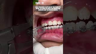 How is Dental Braces Removal Done   Stepwise  braces dentalbraces metalbraces invisiblebraces [upl. by Nodyarg498]