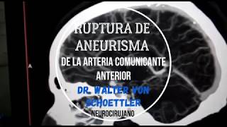 ANGIOTOMOGRAFÍA CEREBRAL  Ruptura de Aneurisma  Dr Walter von Schoettler  Neurocirujano [upl. by Wittenburg]