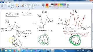 Constrictive pericarditis Etiology and presentation [upl. by Ised]