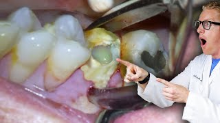 Badly Infected Tooth Extraction Procedure With Pus Coming Out of The Tooth [upl. by Vacla]