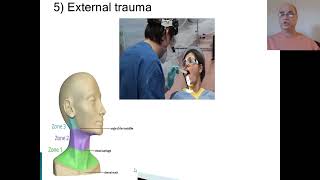 Parapharyngeal abscess Lateral pharyngeal space abscess Head n neck space infecitons [upl. by Anairb245]