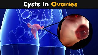 Ovarian Cysts [upl. by Aiuqenehs]