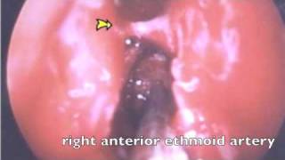 Artery Ligation for Epistaxis [upl. by Mosi]