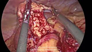 Ovarian Tumor [upl. by Desmond161]