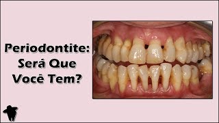 Como Saber se Tenho Periodontite  Periodontite Tratamento e Sintomas [upl. by Slavin575]