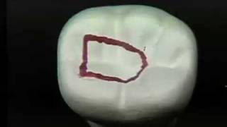 Endodontic Cavity Preparation  Phase I  Posterior [upl. by Deming]