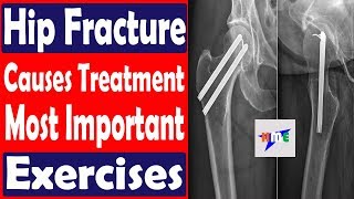 Hip Fracture Causes Treatment Most Important Exercises  HEALTH MADE EASY [upl. by Neelhtakyram726]