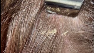 Scalp Psoriasis Treatment scalptreatment scalppsoriasis [upl. by Broddie217]