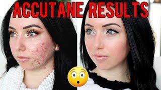 MY ACCUTANE JOURNEY 6 MONTH RESULTS Before amp After Side Effects Would I Do it Again [upl. by Eentrok]