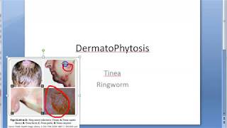 Microbiology 573 a DermatoPhytosis RingWorm Trichophyton Microsporum Epidermophyton ID reaction [upl. by Zaccaria]