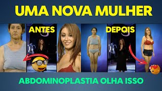 ABDOMINOPLASTIA ANTES E DEPOIS REACT [upl. by Meletius]