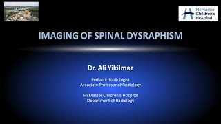 Spinal Dysraphism [upl. by Carew]