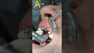 Dr Prakriti from MM Dental College performed post core at Ahead Academy aheadacademy [upl. by Azirb192]