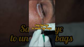 Under eyebags treatment Subcision RF Dermacure rajahmundry eyebagremoval subcision scarless [upl. by Bouchard746]