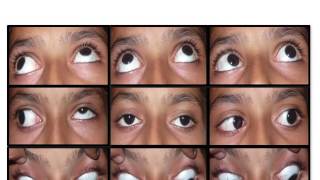 Evaluation of Restrictive Strabismus [upl. by Atidnan]