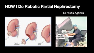 Robotic Partial nephrectomy for left lower pole kidney tumor [upl. by Remliw]