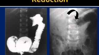 Intussusception Reduction HowTo [upl. by Girard]